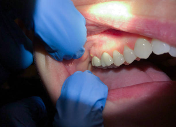 Best Knocked-Out Tooth (Avulsed Tooth) Treatment in Kershaw, SC